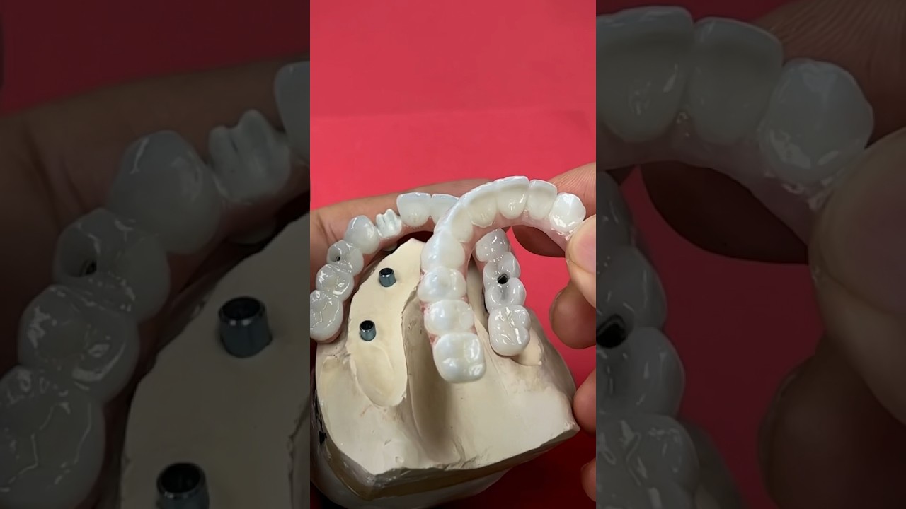 Zirconia or 7-Star: Which is better? #fullmouthdentalimplants #dentist #zirconia #dental #shorts