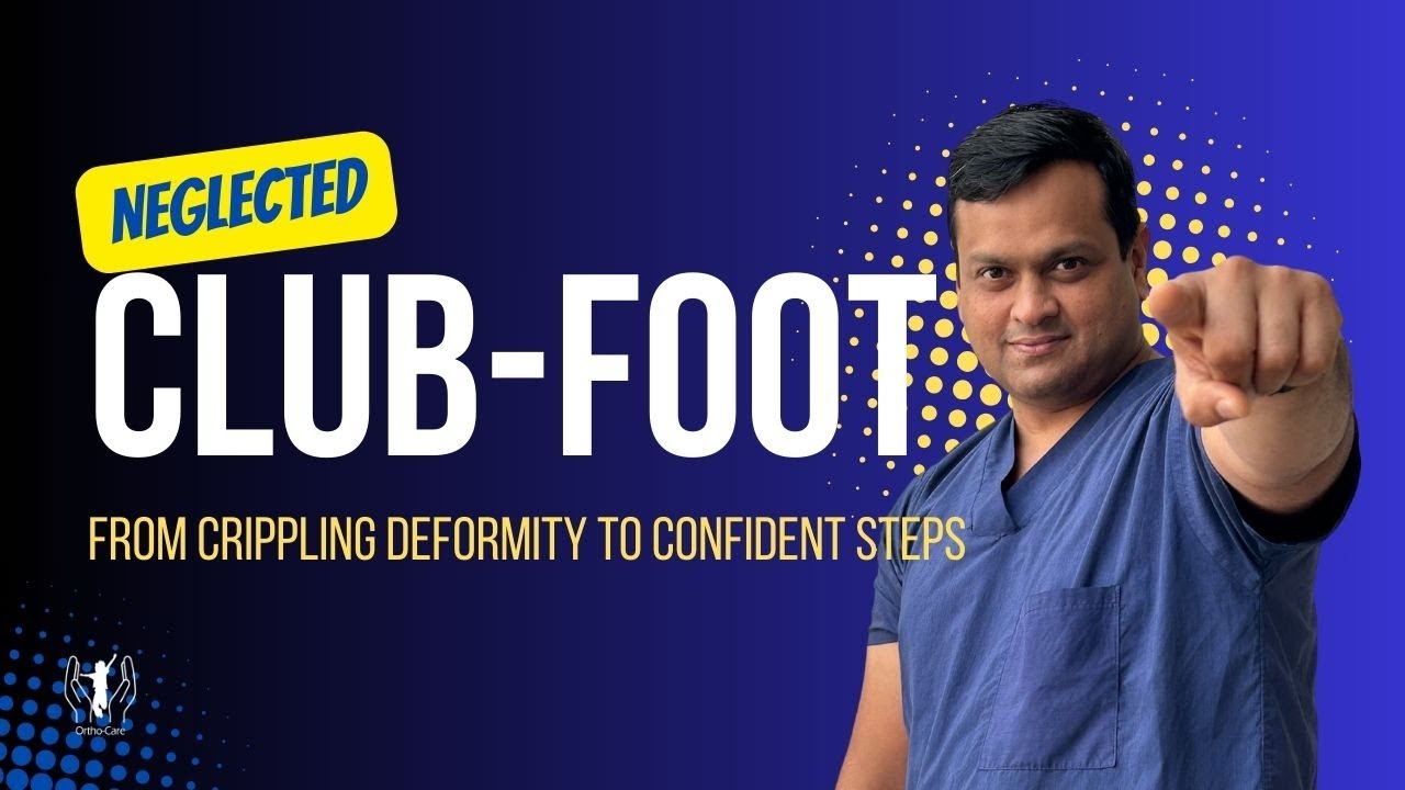 Clubfoot treatment results and parent guide – brace compliance and follow up by Dr Gaurav Jain