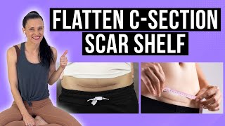 Do This To Your C-Section Scar EVERY DAY To Flatten/Prevent C-Section Scar Shelf