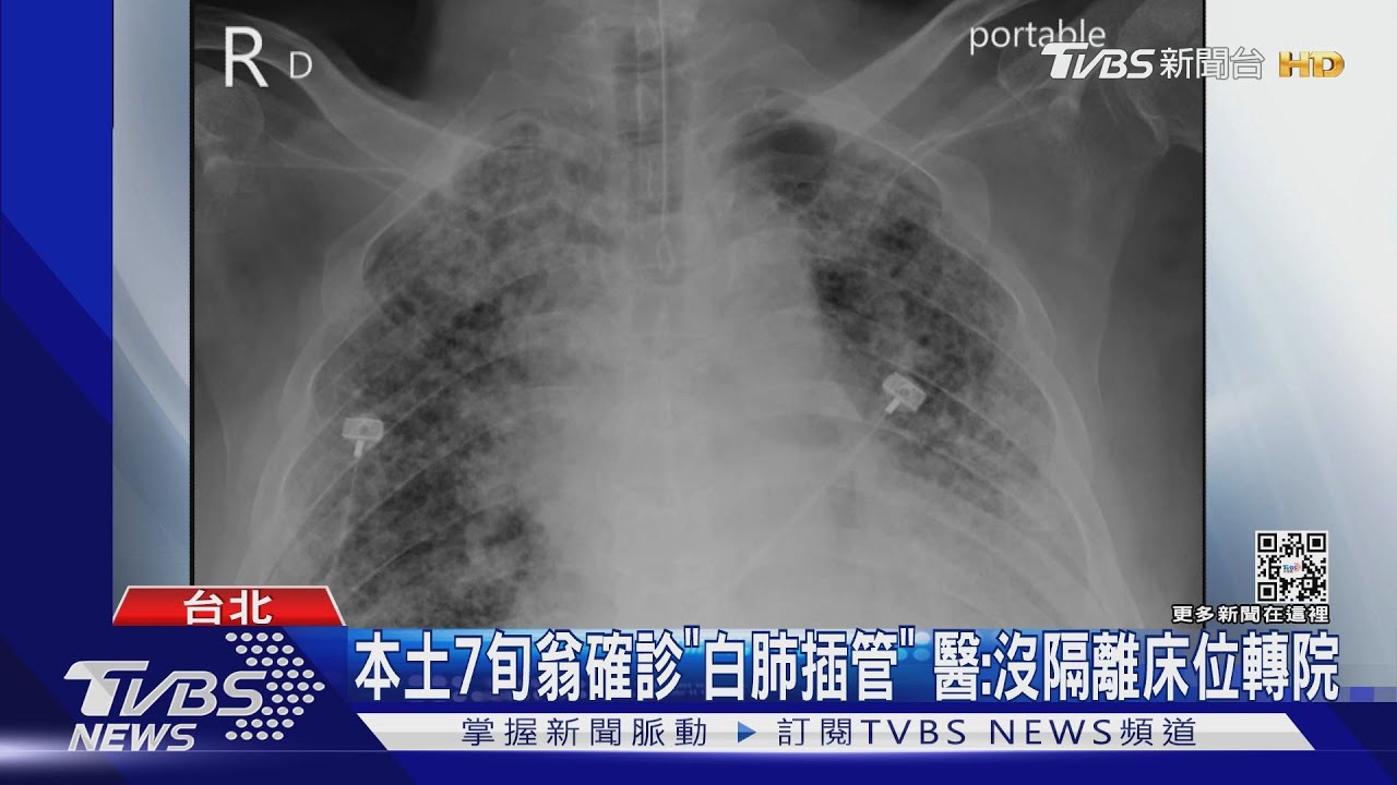 本土7旬翁確診「白肺插管」 醫:沒隔離床位轉院