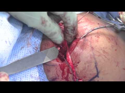 Acromioclavicular Joint Reconstruction with ST Allograft and Fibertape