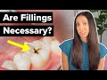 Do You REALLY Need To Get A CAVITY Filled