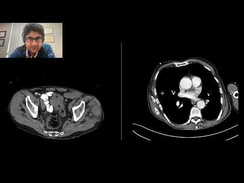 Large Bowel Obstruction