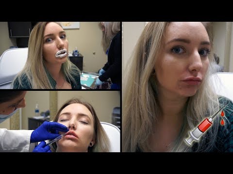 I GOT LIP INJECTIONS | First Time (Process & Healing)
