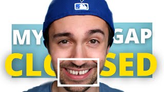 Closing my own GAP TEETH with THIS Simple Trick! [NO BRACES]