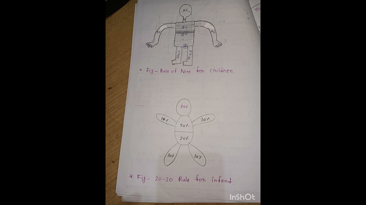 case study on burn in Pediatrics / Child Health Nursing