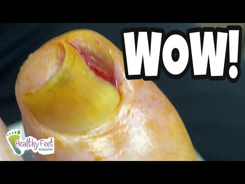 1st YouTube video about are ingrown toenails genetic