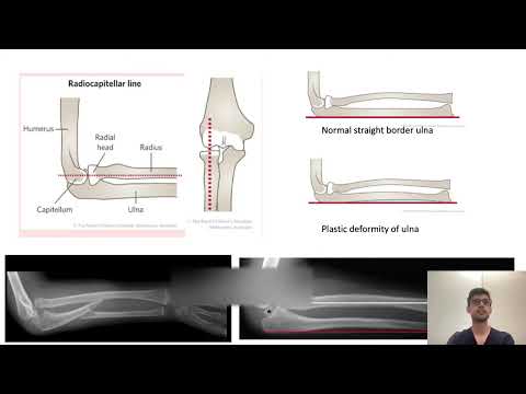 Monteggia and Galeazzi Fracture by Dr Umar Farooq