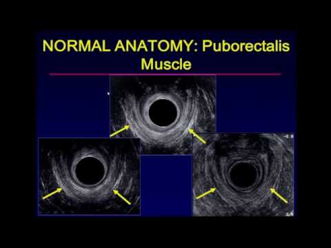 Ultrasound Examination of the Anal Sphincter Video