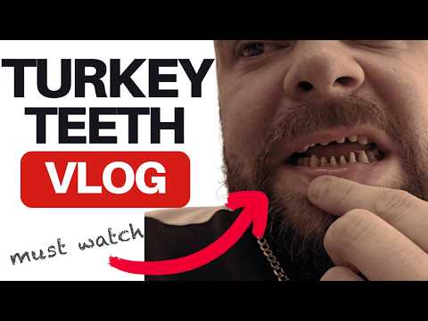 Everything you NEED to know about having TURKEY TEETH (My Experience)