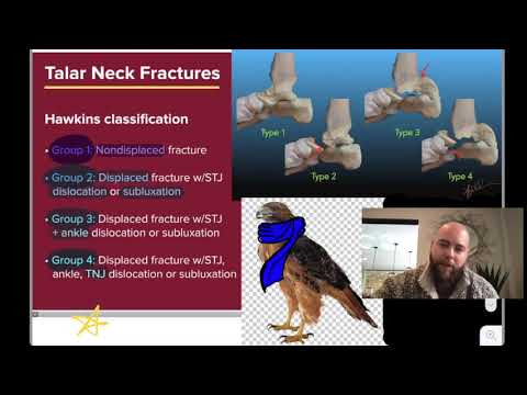 Hawkins Classification of Talar Neck Fractures