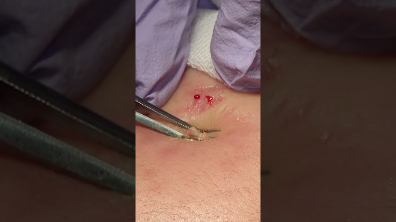 ニキビ圧出～コメドの芯を出すマイクロ排膿【神戸山手クリニック】#ニキビ #ニキビ治療 #角栓 #角栓除去 #blackheads #pimple #pimplepopping