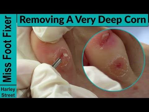 The best way to remove a corn by miss foot fixer Marion Yau Video