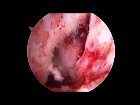 Physeal Sparing ACL Reconstruction