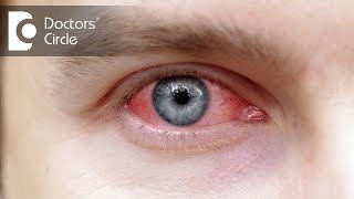 How to manage Eye Allergies? - Dr. Sriram Ramalingam
