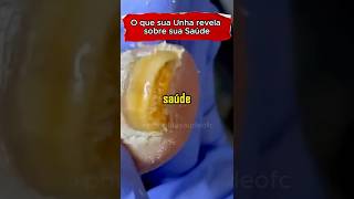 O QUE SUAS UNHAS DIZEM SOBRE SUA SAÚDE #saude #saudavel #unhas #doençasraras