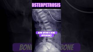 Osteopetrosis #bones #radiology #doctor