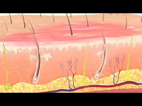 How Burns are Classified and Treated