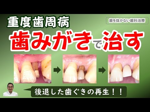 , title : '歯周病、歯みがきで治す：後退した歯ぐきがもとに戻る！！！'