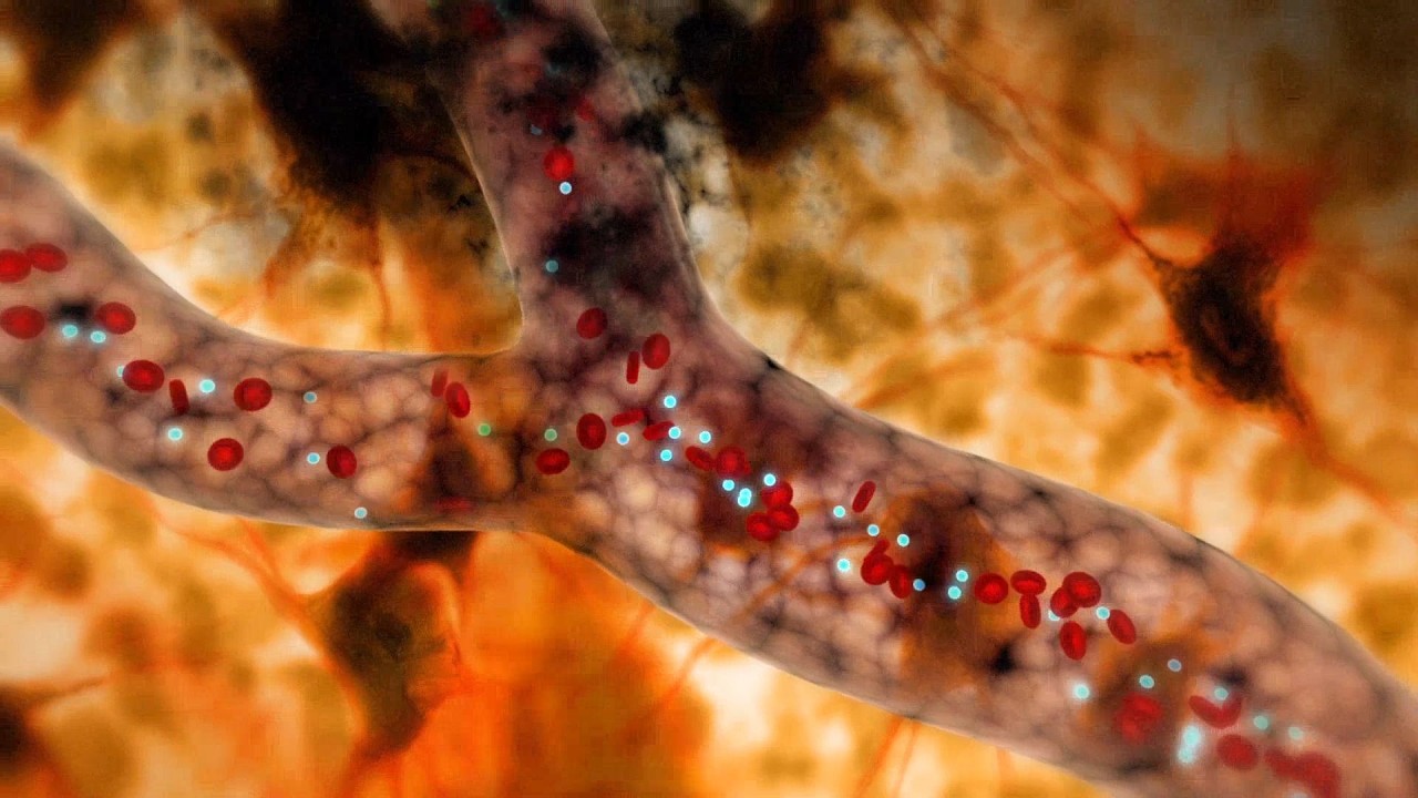 How Stroke Affects Your Brain