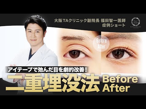 アイテープで何重にも弛んだまぶたを自然な二重へ!