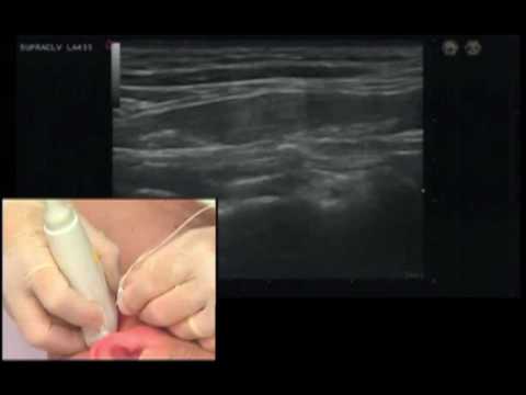 Third Occipital Nerve & Cervical Medial Branch Block Video