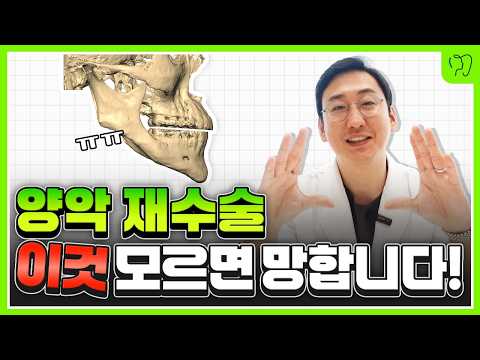 양악수술 재수술 안하려면 필수시청. 양악재수술 이렇게 해야 또 안합니다!!
