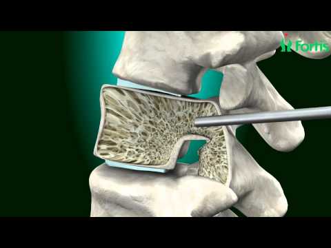 Vertebroplasty & Kyphoplasty ( Spine Surgery) Neuro Surgery; Fortis Healthcare,India Video
