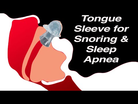 Tongue Suction Device (TSD) to Treat Snoring and Sleep Apnea