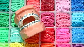 The dangers of "fashion" braces