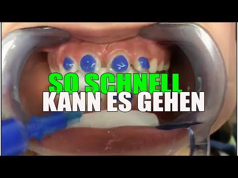 SO SCHNELL wird die FESTE ZAHNSPANGE eingesetzt | Orthodentix