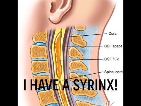 I have Syringomyelia - cyst in spinal chord