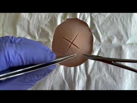 The "X" corner stitch for traumatic lacerations.