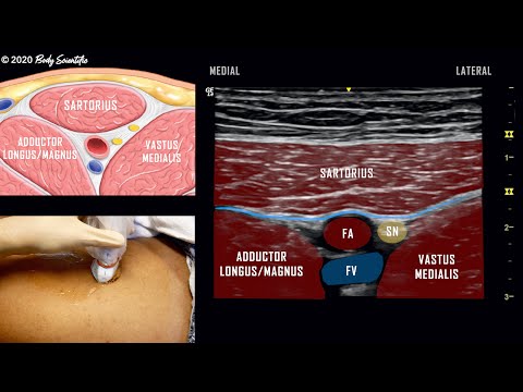 Adductor Canal Block (Saphenous Nerve) // Ultrasound-Guided Demonstration