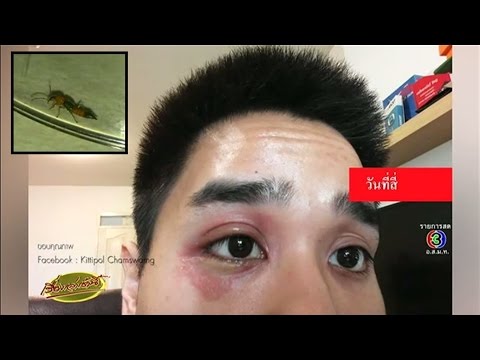 ขี้ผึ้งครีมกับราคาของโรคสะเก็ดเงิน โรคสะเก็ดเงินโรคผิวหนังในเด็ก