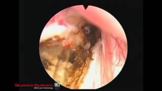 Thulium Laser Enucleation of the Prostate