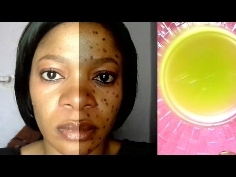 YOU WILL NEVER HAVE SPOTS AGAIN IF YOU WASH YOUR FACE WITH THIS MIXTURE BEFORE GOING TO BED