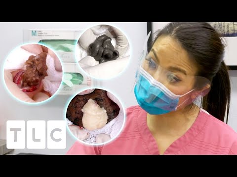 8 Satisfying Minutes Of Popping Cysts, Lipomas And Blackheads! | Dr. Pimple Popper