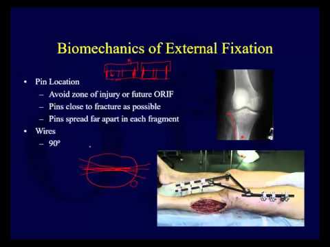 Orthopaedic implants for external fixation