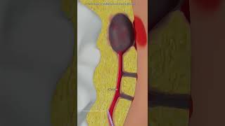 Endoscopic Pilonidal sinus Surgery#surgeryvideo #pilonidalsinus #pilonidalsurgery #sinusremoval