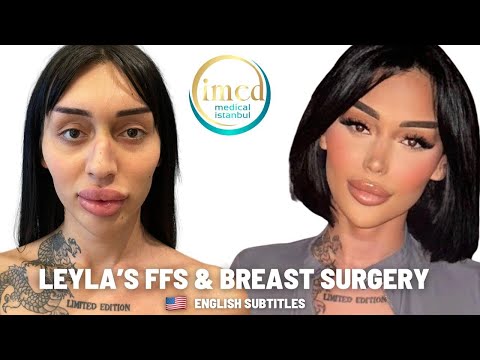The Life-Changing Transformation: Layla's FFS Surgery and Breast Augmentation