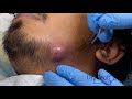 Infected Cyst Drainage on Jawline