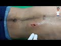 pus exploding out of cavity #pus #surgery #abscess #asmr #patientrelief