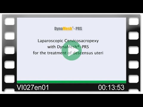 DynaMesh®-PRS - OR-Video: Laparoscopic Cervicosacropexy for the Treatment of Descensus Uteri