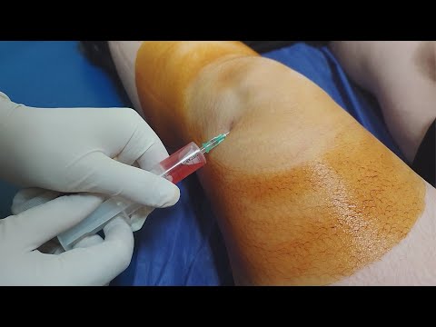 Knee fluid removal | Arthrocentesis | Synovial fluid aspiration procedure