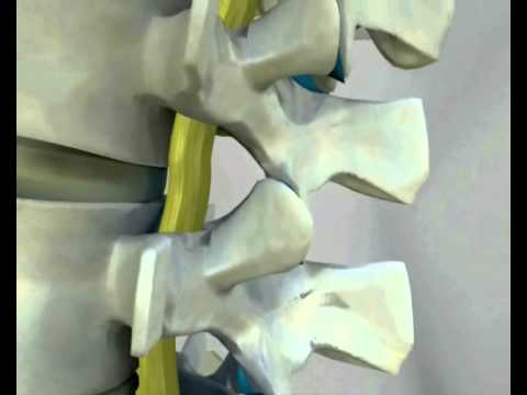 Gel Nise in osteoartrite del ginocchio Filo di lana sul giunto