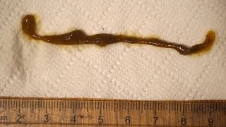 How I Killed My Intestinal Parasites (warning: gross)