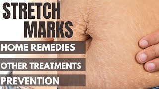How to Get Rid of Stretch Marks Quickly -Stretch Marks Home Remedies Other Treatments and Prevention
