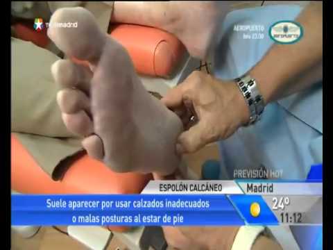 Qué es el espolón calcáneo