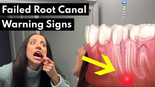 7 Warning Signs Your Root Canal FAILED